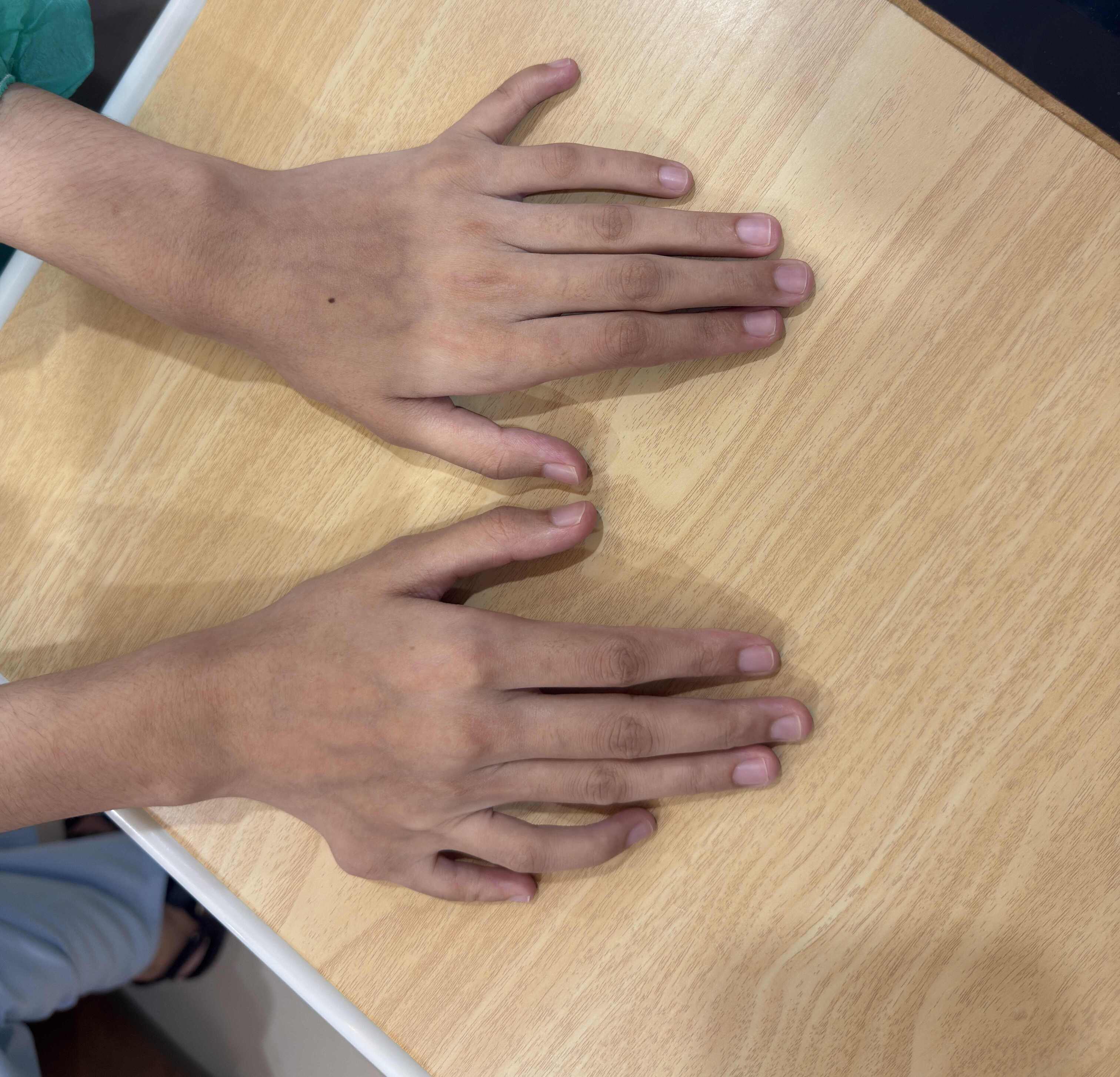 finger beforeafter - Before